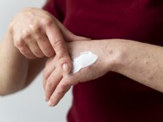 Quemaduras en diciembre: experta explica cómo tratar adecuadamente heridas leves y graves